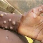 Organização Mundial da Saúde declarada emergência mundial graças ao vírus ‘Mpox’