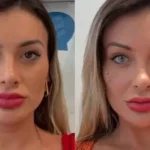 Andressa Urach passa por cirurgia nos olhos na França e revela que mudança marca processo de cura emocional