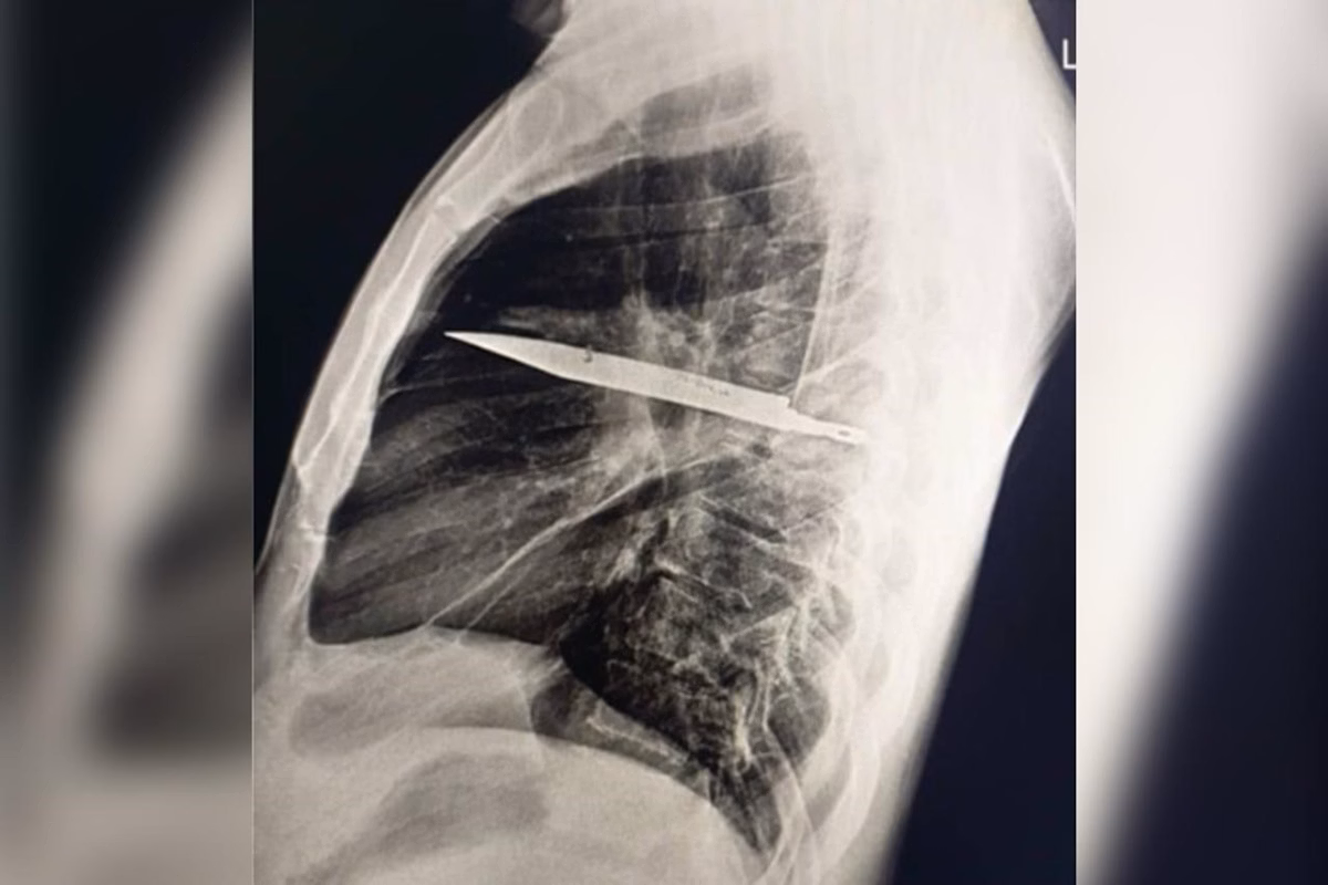 Homem reclama de dores no peito e médicos descobrem lâmina de faca alojada no local há oito anos