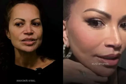 Solange Almeida revela antes e depois de lifting facial e detalha procedimentos estéticos após perda de peso
