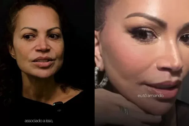 Solange Almeida revela antes e depois de lifting facial e detalha procedimentos estéticos após perda de peso